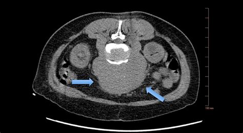 Cureus | Concurrent Incidental Presentation of Primary Retroperitoneal ...