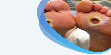 Diabetic Foot Infections