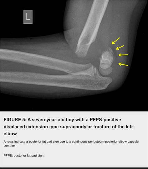 Figure 3 from Role of the Posterior Fat Pad Sign in Treating Displaced ...