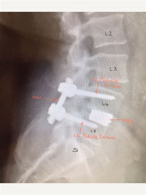 Pars Defect Repair - Spines Dorset