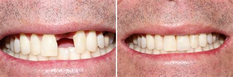 Collaroy Dental | Before & After Gallery | Dental Implant Cases