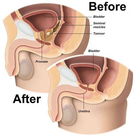 Radical prostatectomy procedure, radical prostatectomy side effects ...