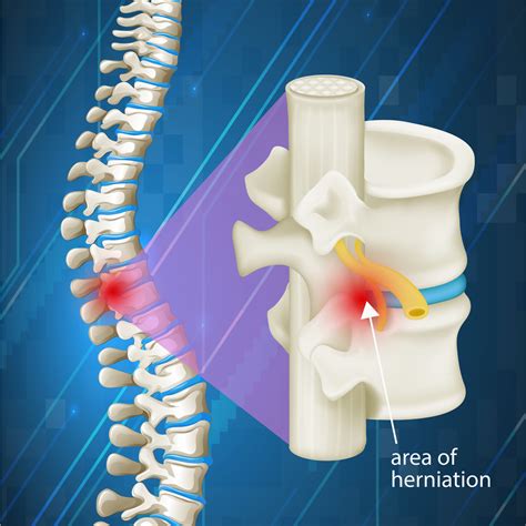 Pinched Nerve Treatment NJ | CNSOmd NJ