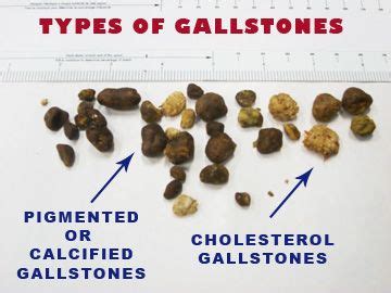 Pin on Gallbladder Symptoms