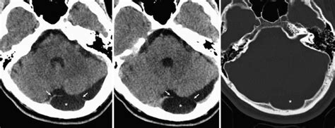 Mega Cisterna Magna and Retrocerebellar Arachnoid Cysts | SpringerLink