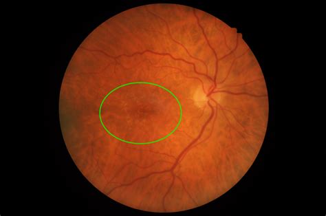 Stages of age-related macular degeneration | Macular Disease Foundation