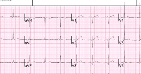 Dr. Smith's ECG Blog: Is it Wellens' Syndrome?