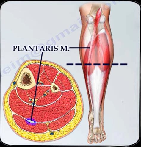 Plantaris Tendon Rupture — OrthopaedicPrinciples.com