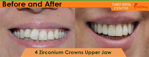 Transformed Smiles: Before & After Zirconium Crowns, Antalya