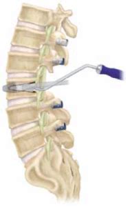 Pedicle Subtraction Osteotomy (PSO) - Matthew D. Hepler, M.D.