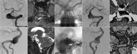 5a-i Reconstructive approach for vertebrobasilar (VB) dolichoectasia.... | Download Scientific ...