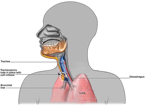 Tracheostomy Tube Insertion