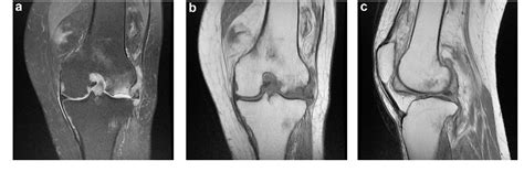 Figure 2 from A Case of Subchondral Insufficiency Fracture of the Knee at Lateral Femoral ...