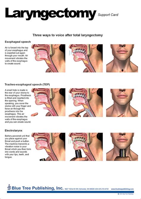 Laryngectomy Anatomical Chart - Etsy