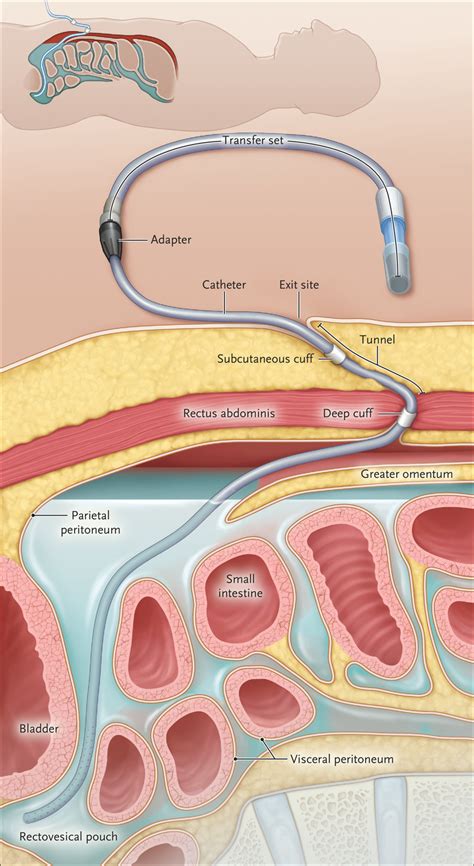 Peritoneal Dialysis Catheter Types