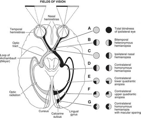 Cranial Nerve 2: Optic Nerve