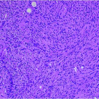 Needle biopsy of the retroperitoneal mass showing a spindle cell ...