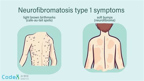 Neurofibromatosis | Codex Genetics