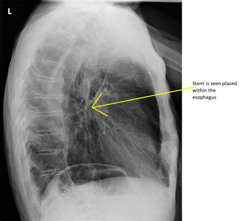 Esophageal cancer surgery - wikidoc