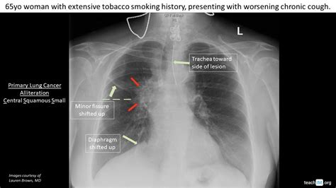 Hilar Mass - Primary Lung Cancer - teachIM