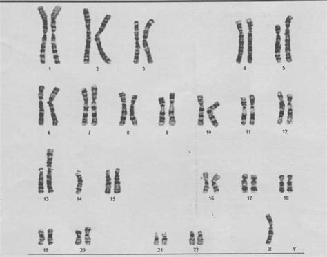 Karyotype of the patient which shows Turner syndrome with... | Download ...