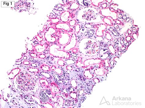 Calcium Phosphate Deposits | Teaching Points | Arkana Labs