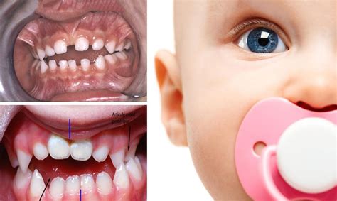 9 Harmful Side Effects of Baby Pacifiers - Awareness Act