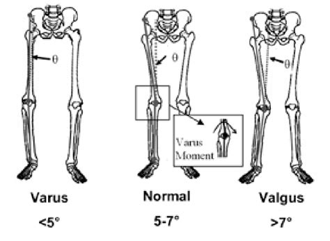 [PDF] The effect of the frontal plane tibiofemoral angle and varus knee moment on the contact ...