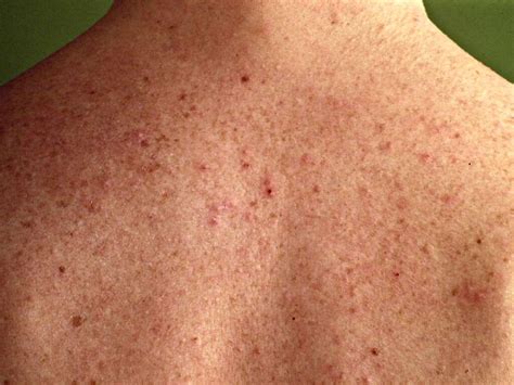 Folliculitis: Folliculitis Causes, Symptoms & Treatments