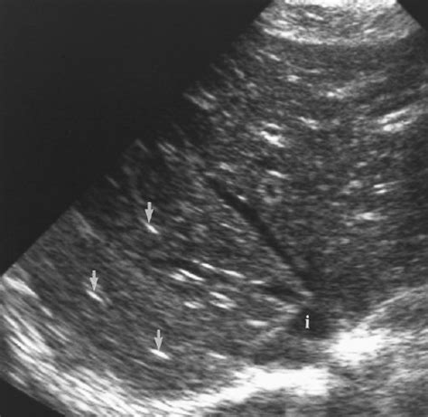 Portal Triad Ultrasound