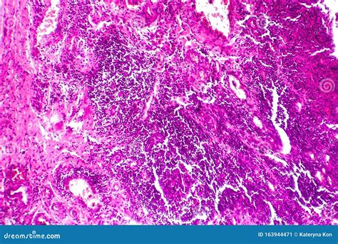 Bladder Cancer, Light Micrograph Stock Image - Image of medicine, neoplasm: 163944471