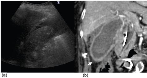 Acute Cholecystitis Ultrasound