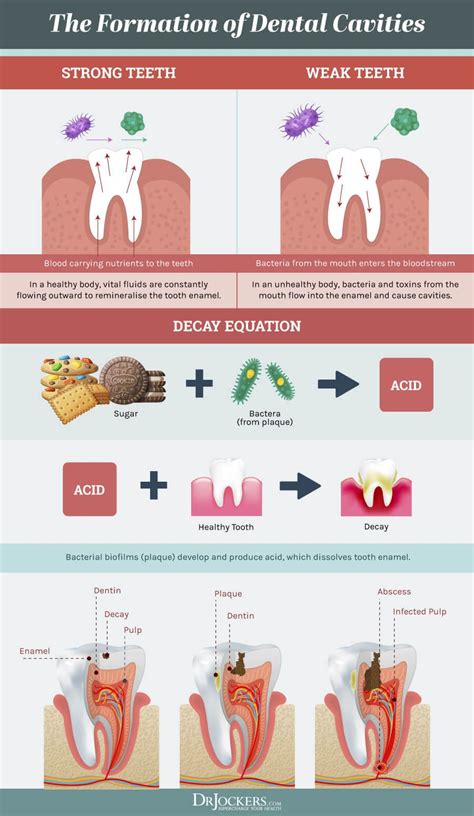 Pin on Tooth decay