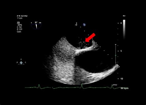 Andrew R. Houghton: How to perform an optimal saline bubble contrast ...