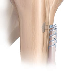 Proximal Biceps Tenodesis Los Angeles | Biceps Tendon Tear Anaheim ...