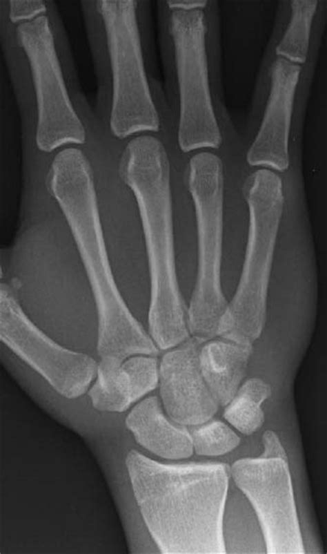 Wrist Injuries | 2011-11-21 | AHC Media: Continuing… | Relias Media