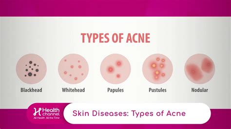 Types of Acne - YouTube