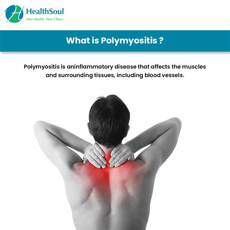 Polymyositis – Causes, Symptoms, Diagnosis, Treatment – Healthsoul