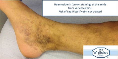 Prof. Mark S Whiteley: Phlebitis and haemosiderin from untreated varicose veins