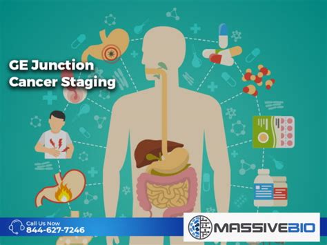 GE Junction Cancer Staging