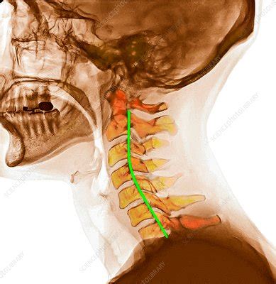 Curvature of the cervical spine, X-ray - Stock Image - C030/8556 - Science Photo Library