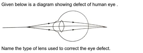 What are the type of eye defects?