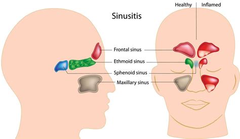 When Do I Really Need Antibiotics for a Sinus Infection? - Fort Worth Sinus