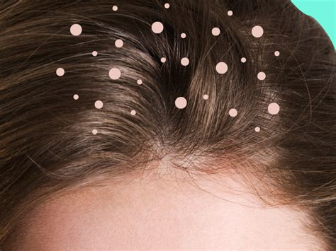 What Causes Dandruff? The Truth Behind 9 Common Dandruff Myths | SELF