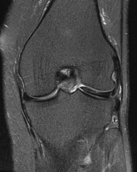 Discoid meniscus - radRounds Radiology Network