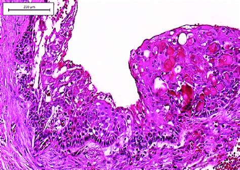 Calcifying Odontogenic Cyst Histopathology