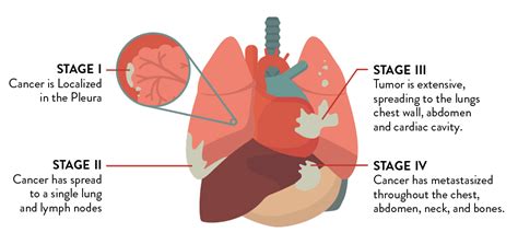 Stages of Mesothelioma Cancer | Your Great Source For All Information