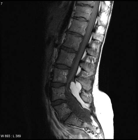 Lipomyelomeningocele and tethered cord | Radiology Case | Radiopaedia.org