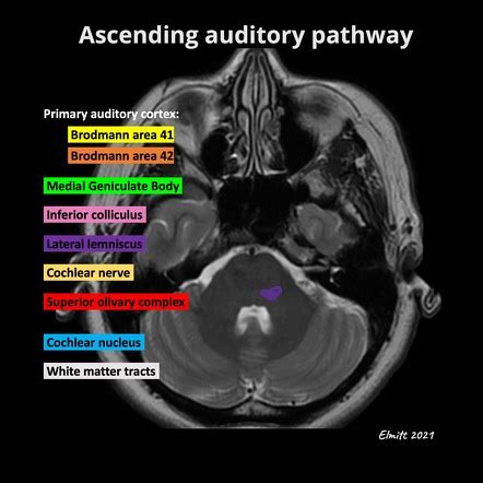 Inferior Colliculus Mri