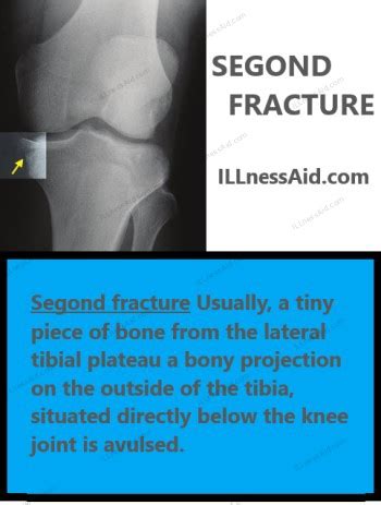 Segond Fracture: Roles of PT & OT - ILLnessAid